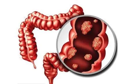 【医疗科普】结直肠癌，离我们有多远？